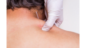 Understanding the Difference between Dry Needling and Acupuncture