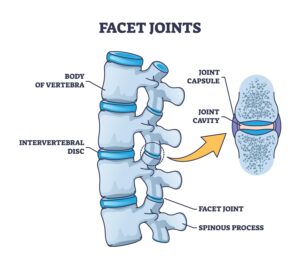low back pain facet syndrome