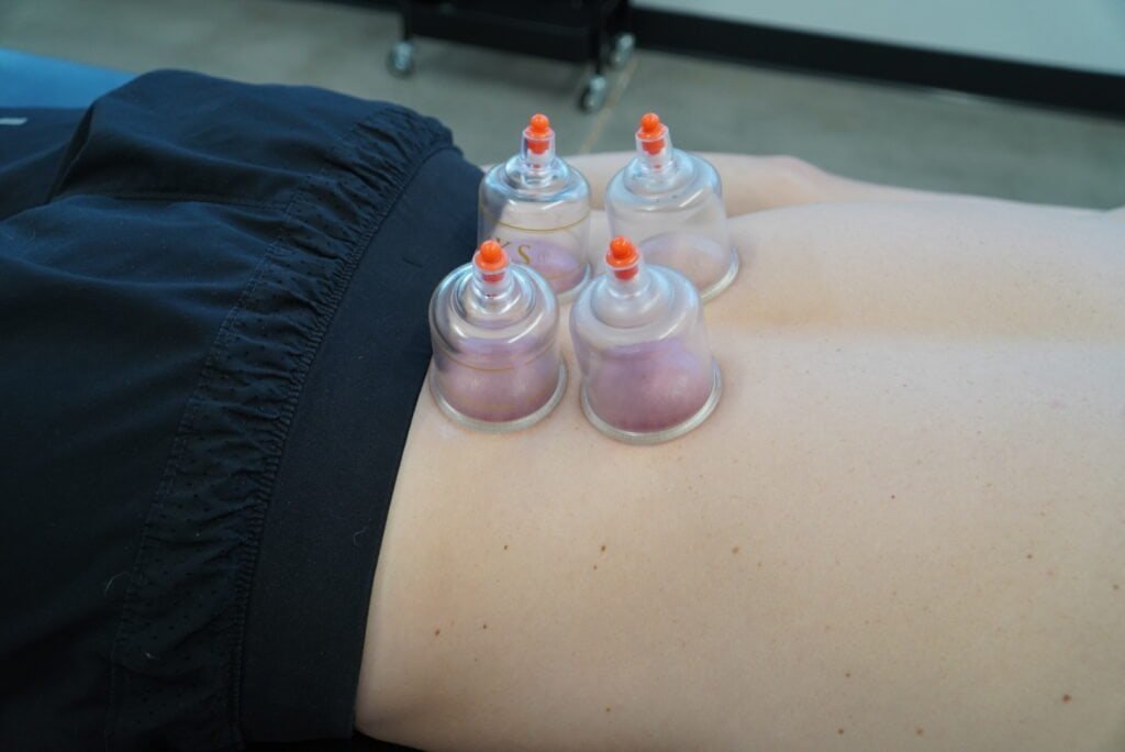 Cupping
