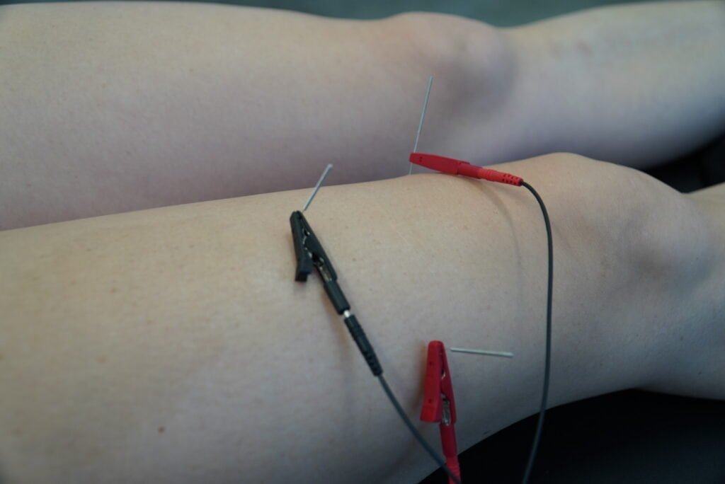 E-Stim Dry Needling